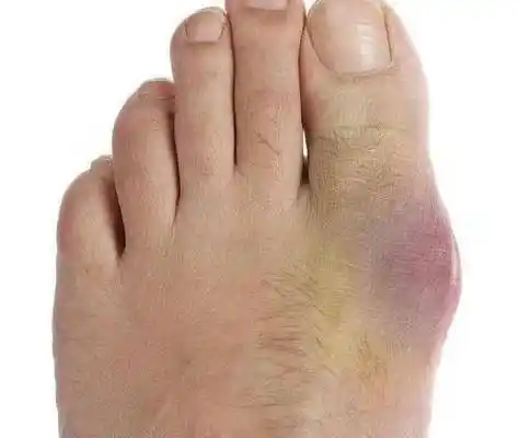 痛风通常在身体的一侧首次发作(多数情况下是下肢,如大脚趾关节),而不