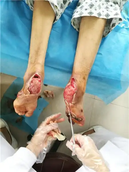 糖尿病足溃疡久治不愈合,专业清创少不了_济南长征疑难病研究所