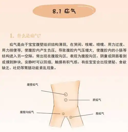 i宝贝丨"疝气"到底是什么鬼?宝宝会不会很难受?