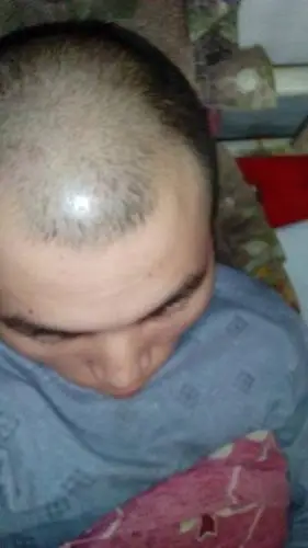 天生秃鬓角是遗传吗?好难看啊