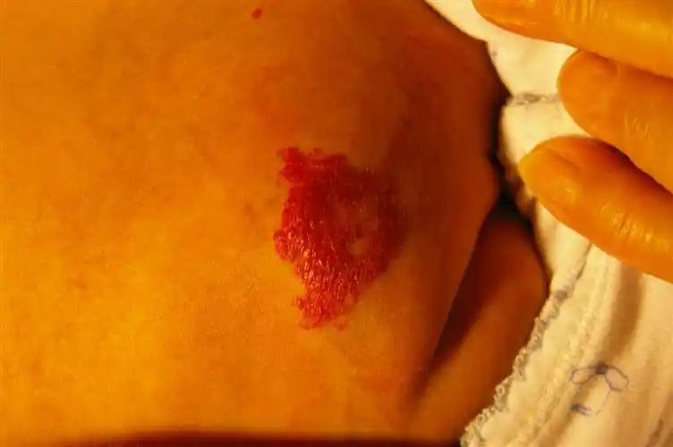 请问7周大的宝宝背上的大血管瘤要治疗么?(图)