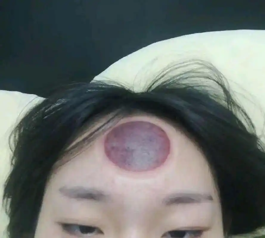 网友:真的有人会在脑门上拔罐吗?