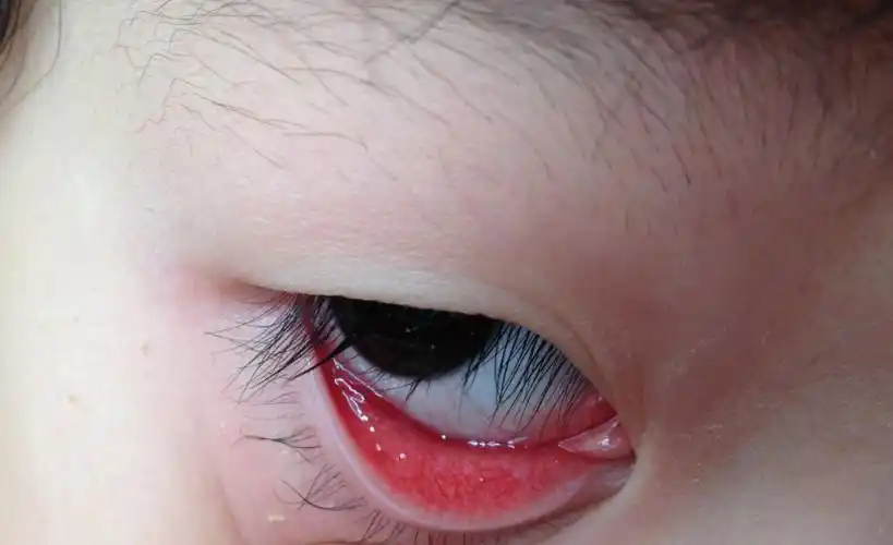 是什么问题 上火吗 在发红的前一天在幼儿园被其他小朋友用手揉过 &