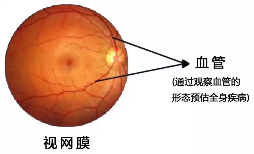 唐由之:老年黄斑变性治疗经验