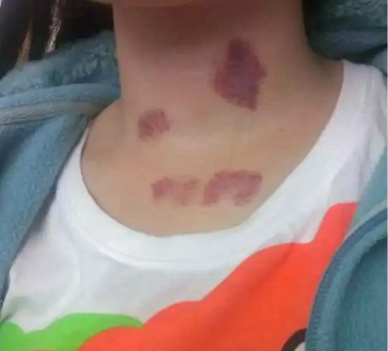 在脖子上"种草莓"是有健康风险的.