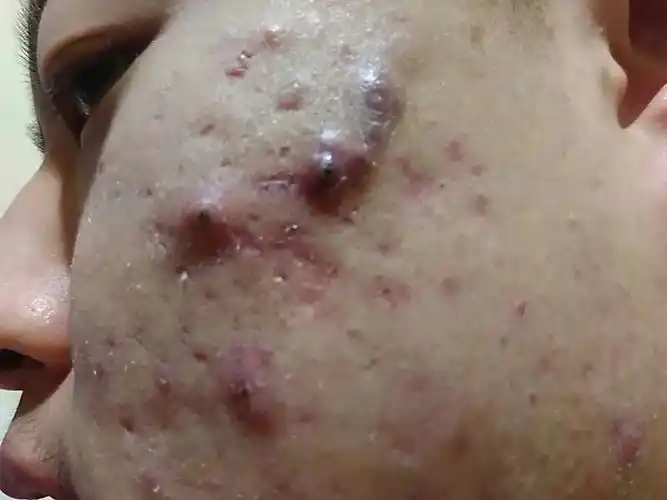 脸上总是起青春痘,我17岁,关键痘痘都是紫色的,而且很难下去还特别