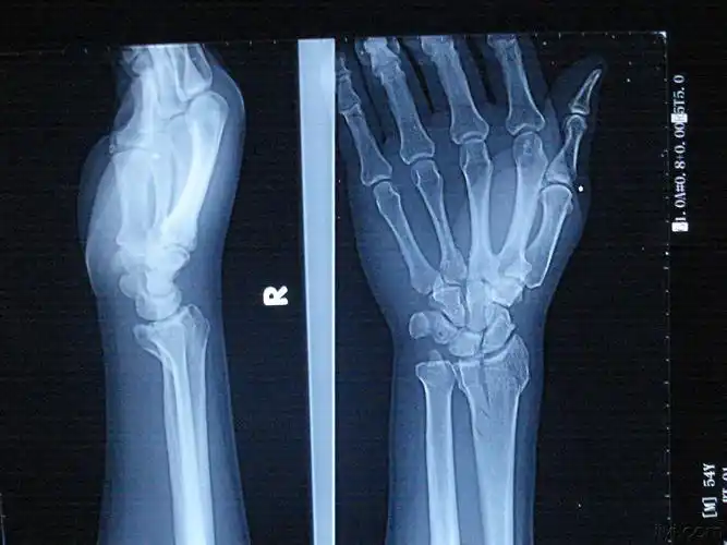 右侧桡骨远端骨折怎么治疗