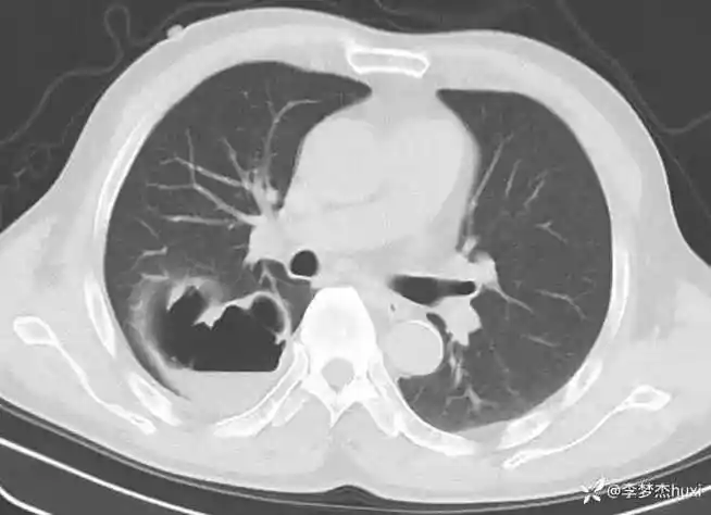 男性60岁右侧肺脓肿病原体你可能想不到