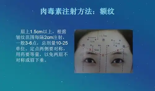 肉毒素注射方法:额纹
