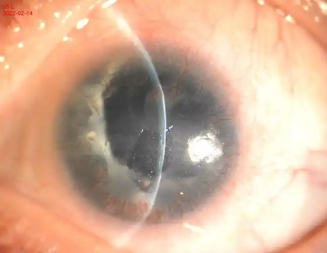 挽回宝贵视力消除眼疼困扰我院成功实施一例先天性无虹膜症继发青光眼