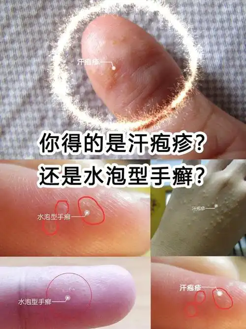 手指缝里的小水泡汗疱疹