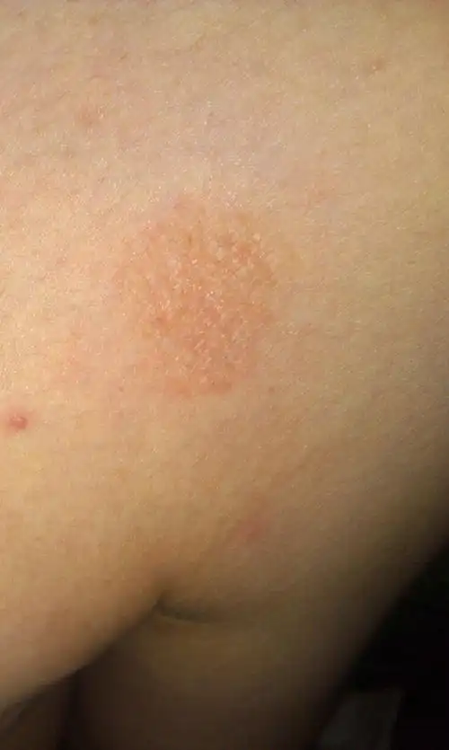 皮肤斑状 掉皮 不疼不痒 是怎么回事呢?