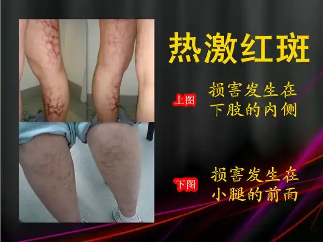 经常在碳火边烤有什么危害