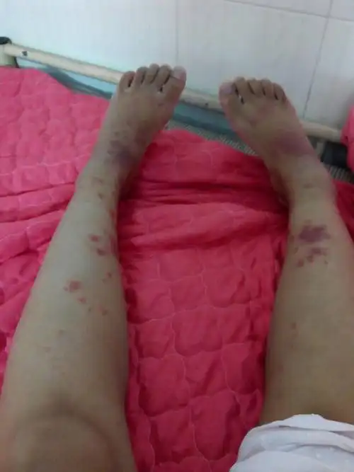 想请问一下这个是什么?很痒而且像是蚊子咬的,差不多一个礼拜了