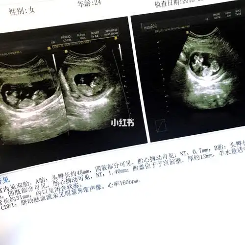 二胎双胞胎双绒双羊孕期记录