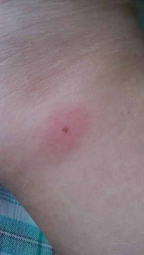 我被虫子咬了,那种虫子是棕色,两头尖,把它捏死之后都是血.