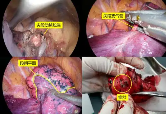 微创精准宝鸡市中医医院通过肺癌手术治疗最大限度保留患者肺功能