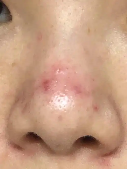 鼻子上的这种红痘痘怎么处理啊已经破了一个星期了