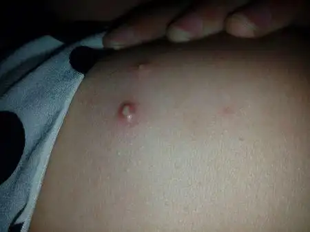 之前胸口也出现过一个,不知道是什么和什么原因,怎么办,谢谢