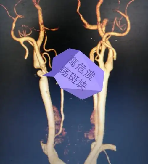 颈动脉腔内龛影.