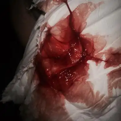 怀孕六周左右出血了,出血第四天了,保胎还能保住么,怀孕一个月的时候