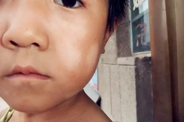 实际上,孩子脸上的白斑并不是癣,很可以是脾胃虚弱导致的.