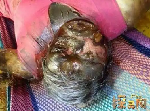 腐败巨人观恶心至极人死后尸体会不断膨胀巨大化如同气球2