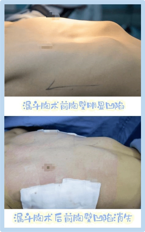 【东方播报】你是否知道:青春期是治疗鸡胸或漏斗胸的最佳时机_闫天生