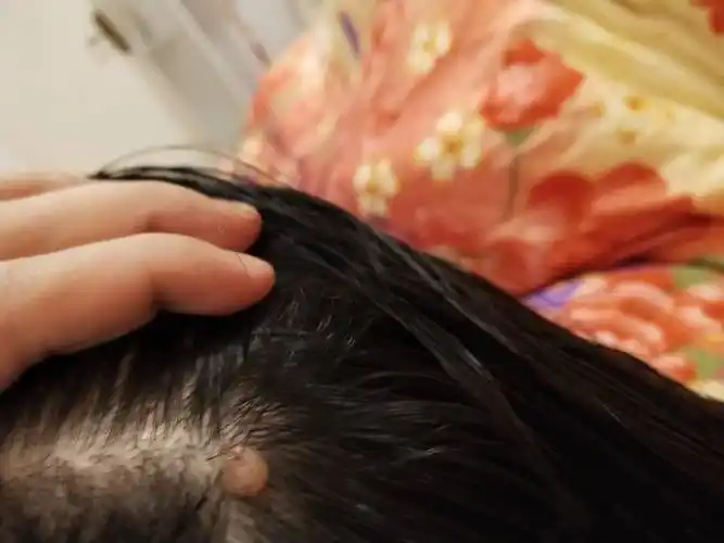 我头皮上有个肉一样的东西,感觉比前几年大了,不疼不痒