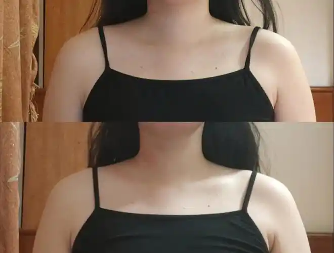 练了三天,好像锁骨有一点明显了,但高低肩和锁骨不对称也明显了.