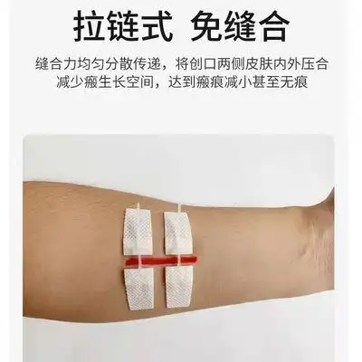 医用链式减张皮肤免缝胶带伤口张贴剖腹产无需缝针创口贴