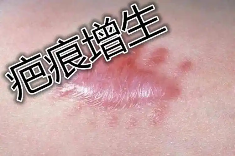 甲状腺手术留下的疤痕长久不消,这个方法我能吹爆!真的猛啊!