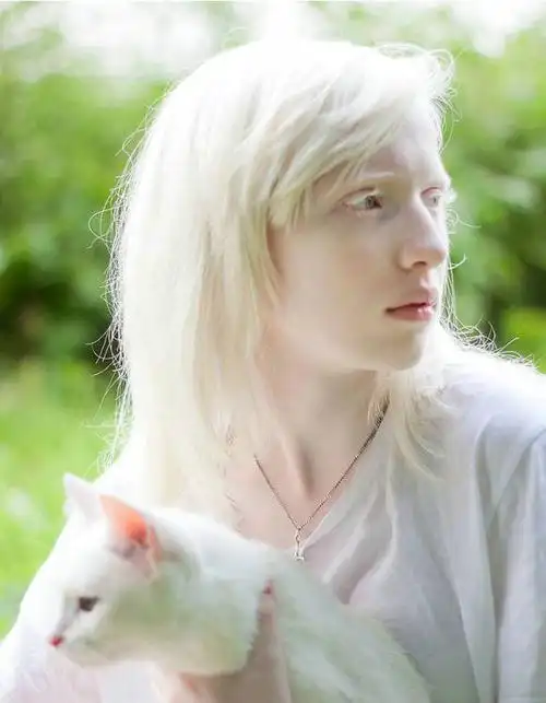 女孩患罕见白化病全身雪白,从小遭人嘲笑,如今逆袭成模特!