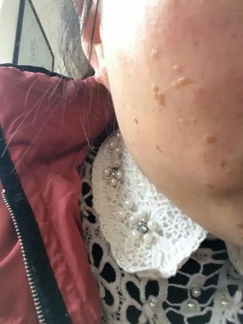 脸上轻微扁平疣图片