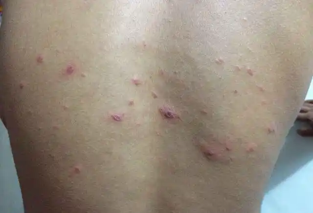 后背抠下脂肪粒,暗示百万螨虫在后背"为非作歹",记住3招灭螨