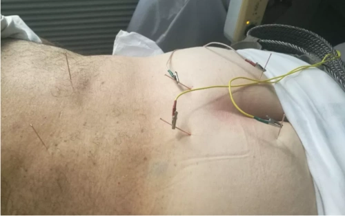 意大利针灸师中国旧疾突发,亲身感受"盆底六针"的神奇疗效