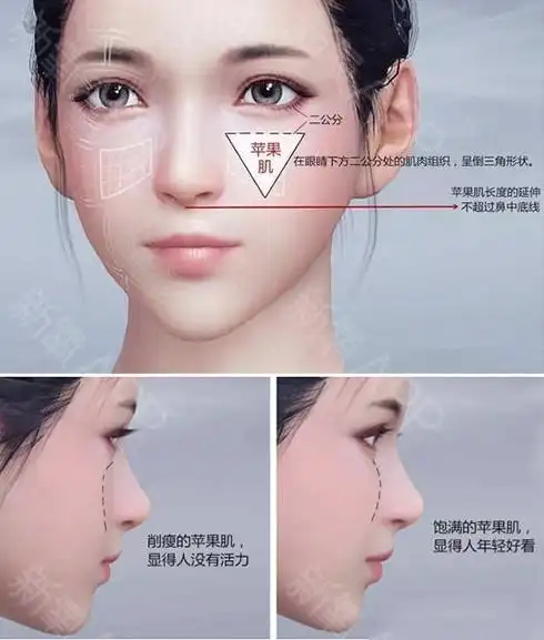 苹果肌和高颧骨位置差不多,让人傻傻分不清?