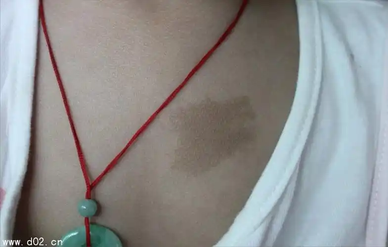 胎记算命胎记的位置与命运