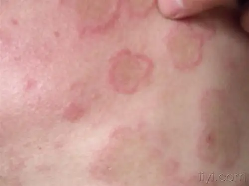 远心性环状红斑(有病理) - 皮肤及性传播疾病讨论版 - 爱爱医医学论坛