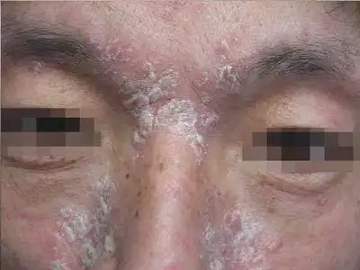 皮肤疾病 银屑病 长在面部?