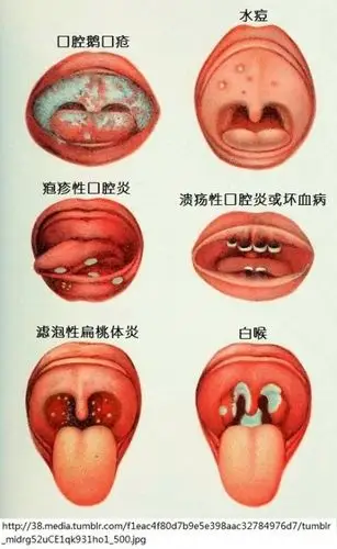 儿童疾病的口腔表现