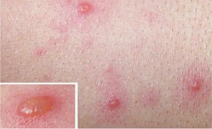 小孩子手足口病手部症状图片_有来医生