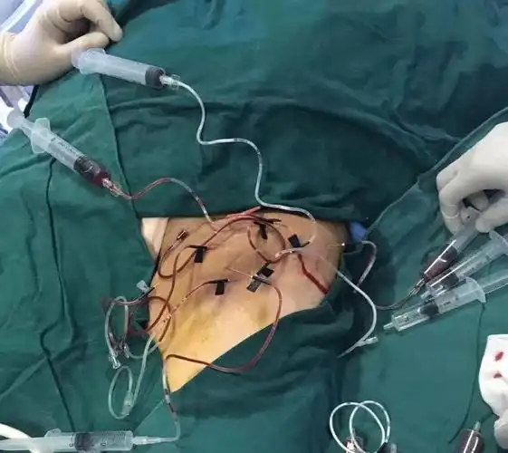 血管硬化技术,微创外科中的微创