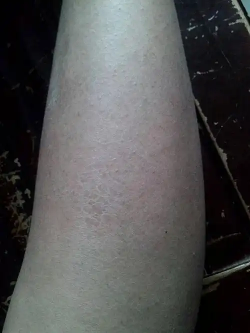 我的腿一年四季都呈龟裂状是不是皮肤有什