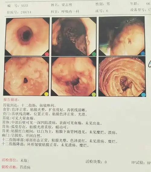 慢性胃炎,口服布洛芬后出现消化性溃疡,消化道大出血