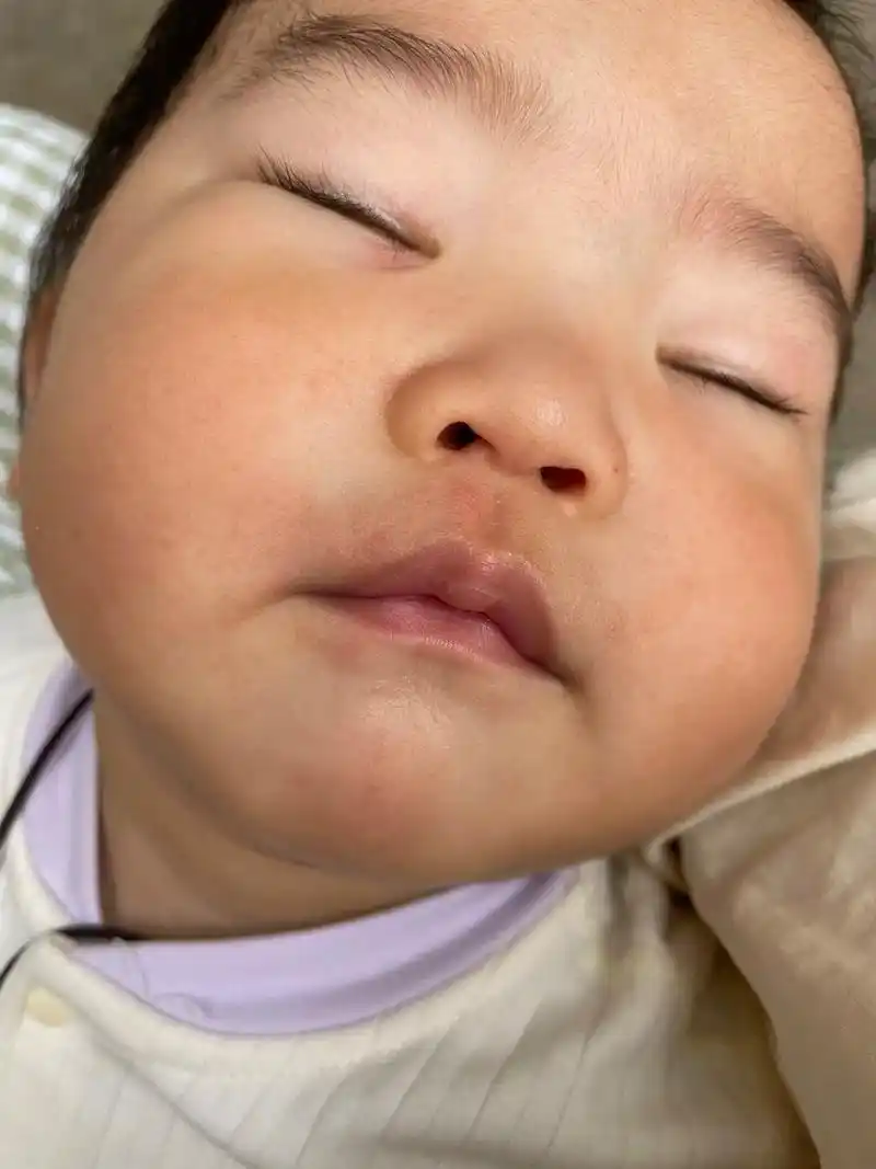 牛奶蛋白过敏宝宝 恩敏舒氨基酸转纽康特氨基酸的不适,湿疹复发