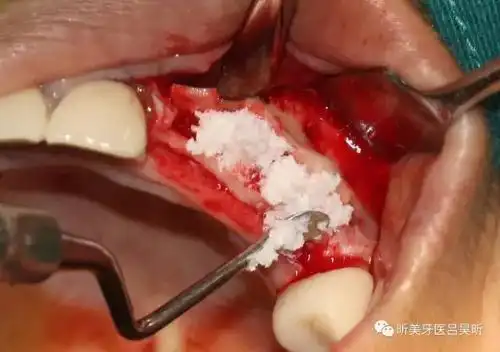 以便获得初期稳定性 四个月后复查,软组织及骨骨组织成型良好,牙槽骨