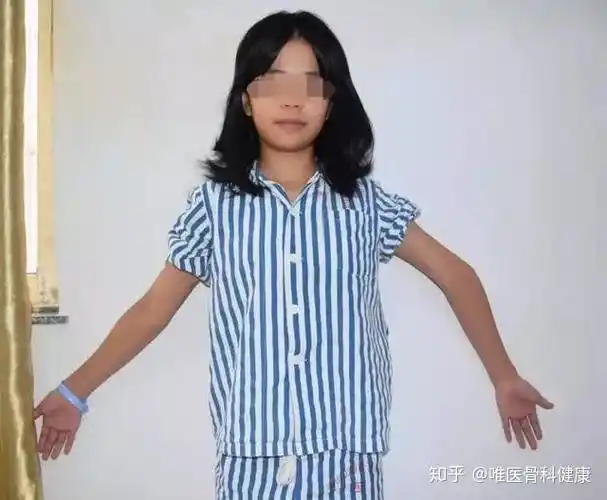 一,肘内翻的临床表现