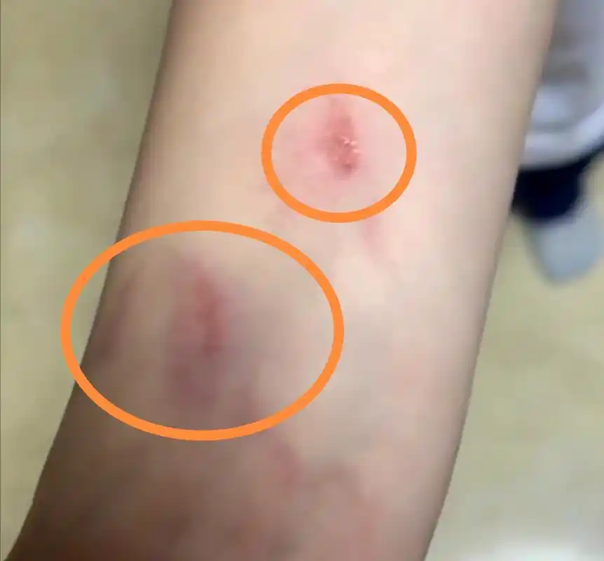揭阳某私立小学女生被体罚手臂淤青破皮,家长质疑被班主任踢出群_手机