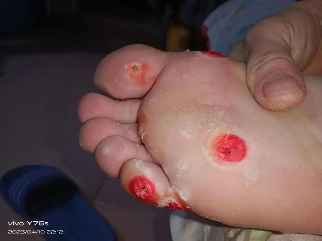 为什么长那么多鸡眼呀!一走路都就痛,问了很多人说做手术不好, - 抖音